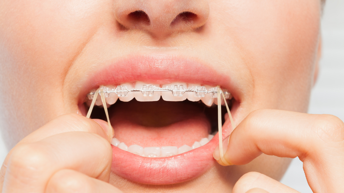 SEO Elastics for Braces